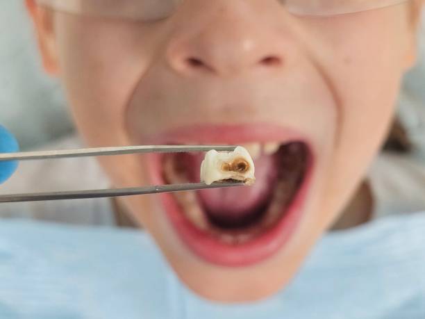 Best Emergency Treatment for Dental Infections or Abscesses in De Pue, IL